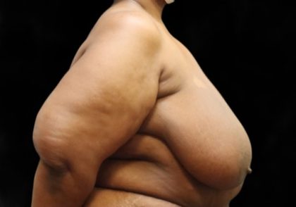 Breast Reduction Before & After Patient #12812