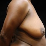 Breast Reduction Before & After Patient #12869