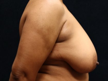 Breast Reduction Before & After Patient #12876
