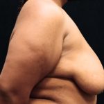 Breast Reduction Before & After Patient #12897