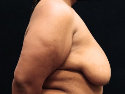 Breast Reduction Before & After Patient #12897