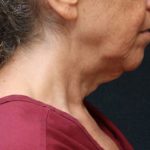 Chin Augmentation Before & After Patient #12904