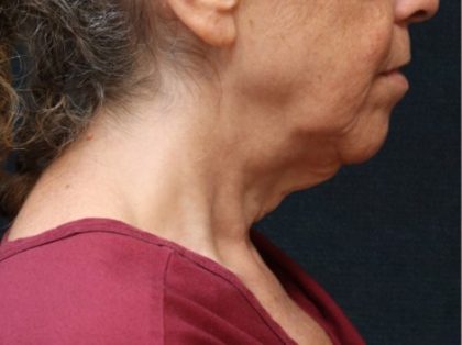Chin Augmentation Before & After Patient #12904