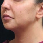 Chin Augmentation Before & After Patient #12913