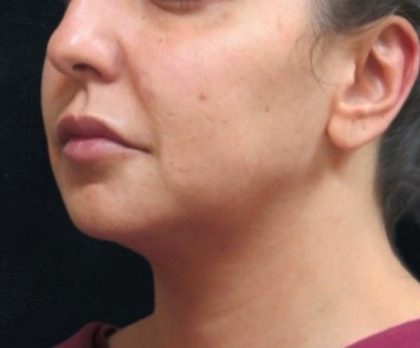 Chin Augmentation Before & After Patient #12913