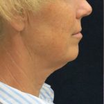 Chin Augmentation Before & After Patient #12920