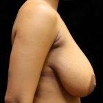 Breast Lift Before & After Patient #12402