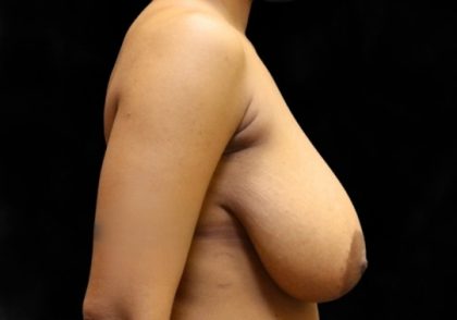 Breast Lift Before & After Patient #12402