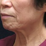 Chin Augmentation Before & After Patient #12929