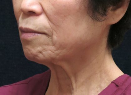 Chin Augmentation Before & After Patient #12929