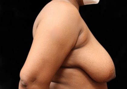 Breast Lift Before & After Patient #12406