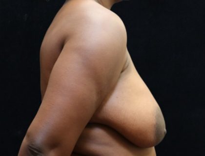 Breast Asymmetry Before & After Patient #13034