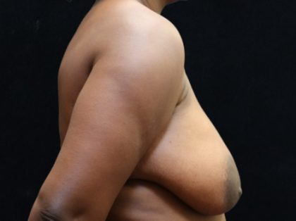 Breast Asymmetry Before & After Patient #13030