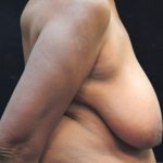 Breast Reduction Before & After Patient #12801