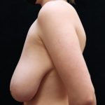 Breast Reduction Before & After Patient #12826