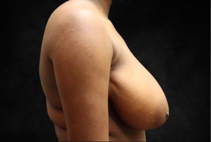 Breast Reduction Before & After Patient #13027