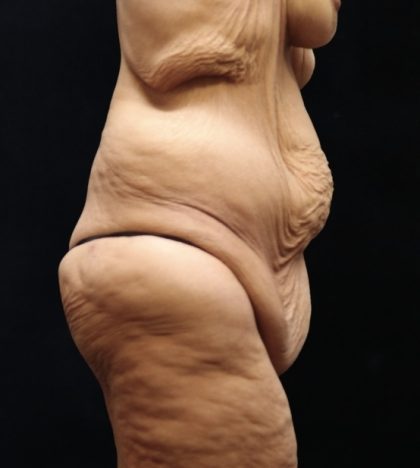 Lower Body Lift Before & After Patient #13044