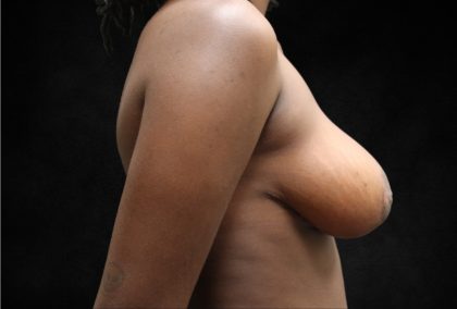 Breast Lift Before & After Patient #12409