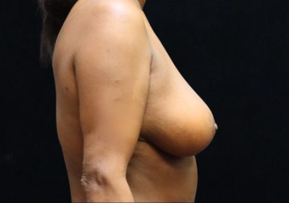 Breast Lift Before & After Patient #12413