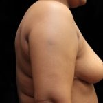 Breast Asymmetry Before & After Patient #12338