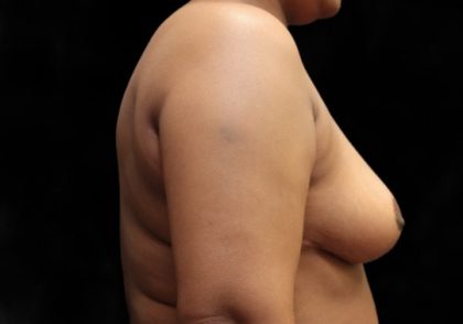 Breast Asymmetry Before & After Patient #12338