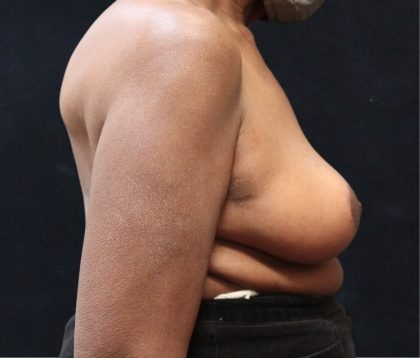 Breast Lift Before & After Patient #12743