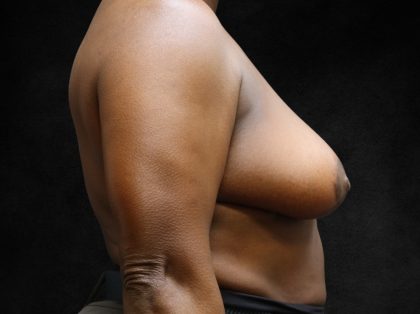 Breast Lift Before & After Patient #12765