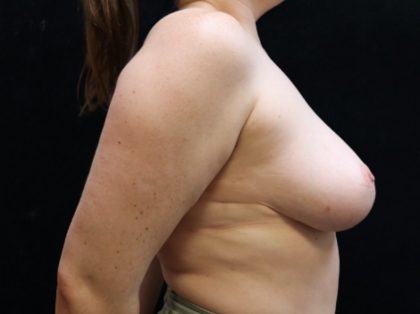 Breast Lift Before & After Patient #12778