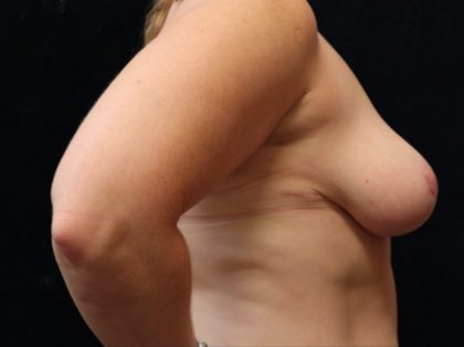 Breast Lift Before & After Patient #12793