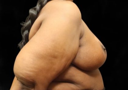 Breast Reduction Before & After Patient #12812