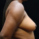 Breast Reduction Before & After Patient #12819