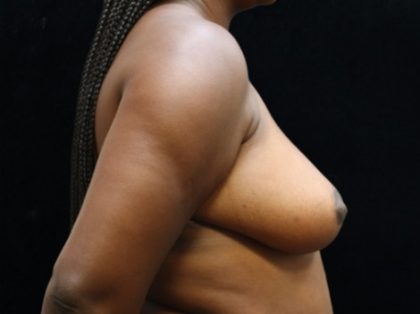 Breast Reduction Before & After Patient #12819