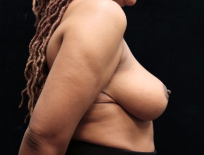 Breast Asymmetry Before & After Patient #12341