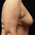 Breast Reduction Before & After Patient #12876