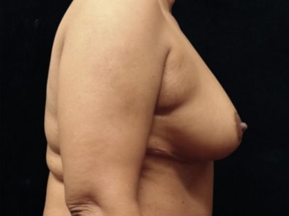 Breast Reduction Before & After Patient #12876