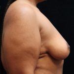 Breast Reduction Before & After Patient #12897