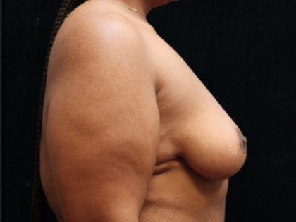 Breast Reduction Before & After Patient #12897