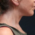 Chin Augmentation Before & After Patient #12904