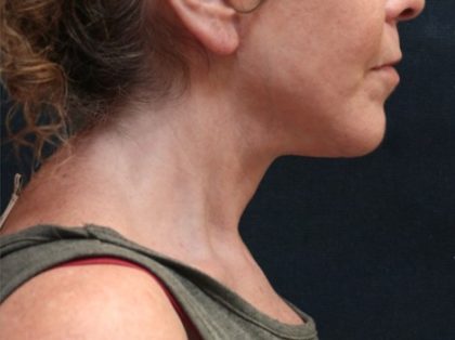Chin Augmentation Before & After Patient #12904