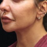 Chin Augmentation Before & After Patient #12913