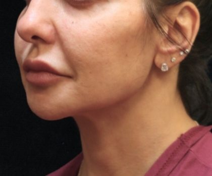 Chin Augmentation Before & After Patient #12913