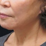 Chin Augmentation Before & After Patient #12929