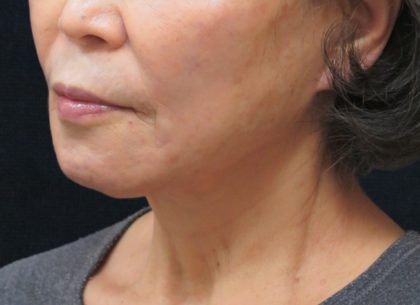 Chin Augmentation Before & After Patient #12929