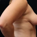 Breast Reduction Before & After Patient #12936