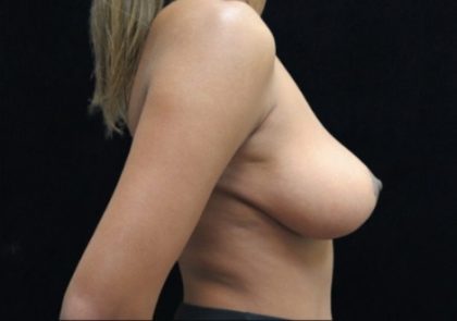 Breast Lift Before & After Patient #12407