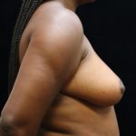 Breast Asymmetry Before & After Patient #13034