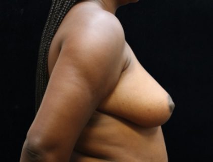 Breast Asymmetry Before & After Patient #13034