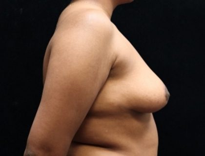 Breast Asymmetry Before & After Patient #13031