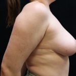 Breast Asymmetry Before & After Patient #13029