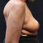 Breast Reduction Before & After Patient #12801